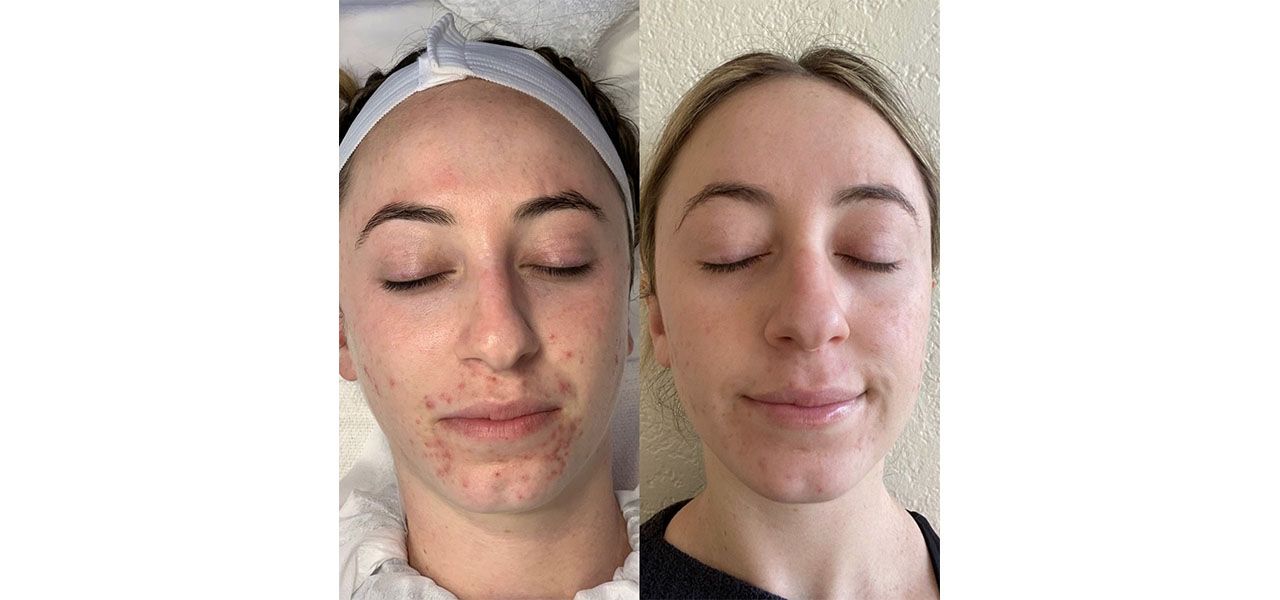 blemishes-2